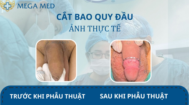 Hình ảnh trước và sau khi cắt bao quy đầu 